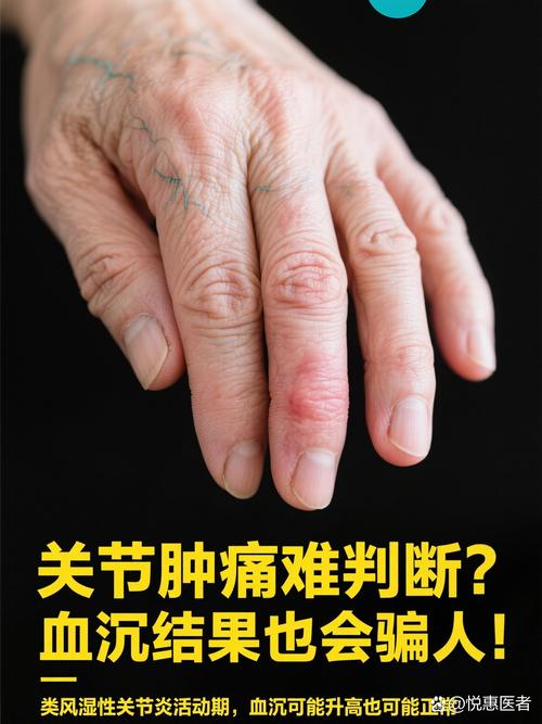 风湿因子类风湿因子血沉