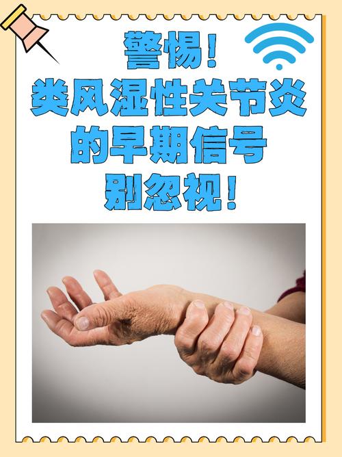 风湿因子高会得类风湿吗