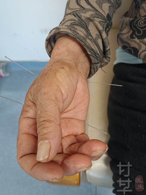 手风湿类风湿的针灸图片