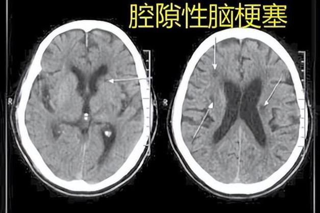 双侧基底节区腔隙性脑梗