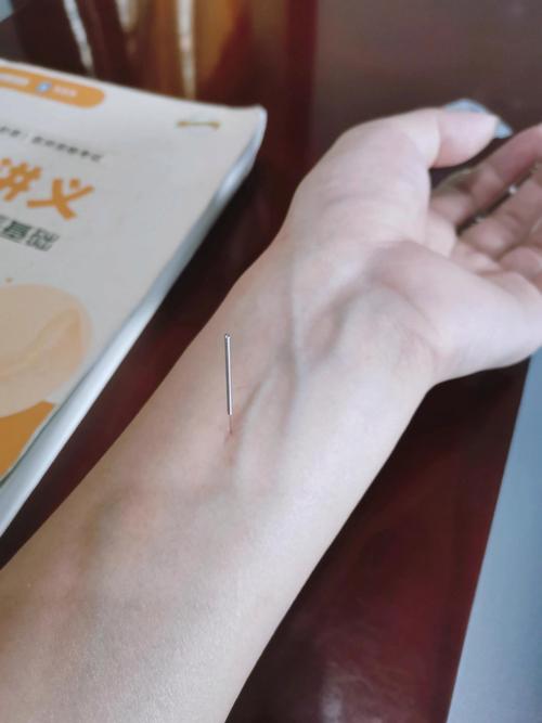 手指麻木针灸哪些穴位