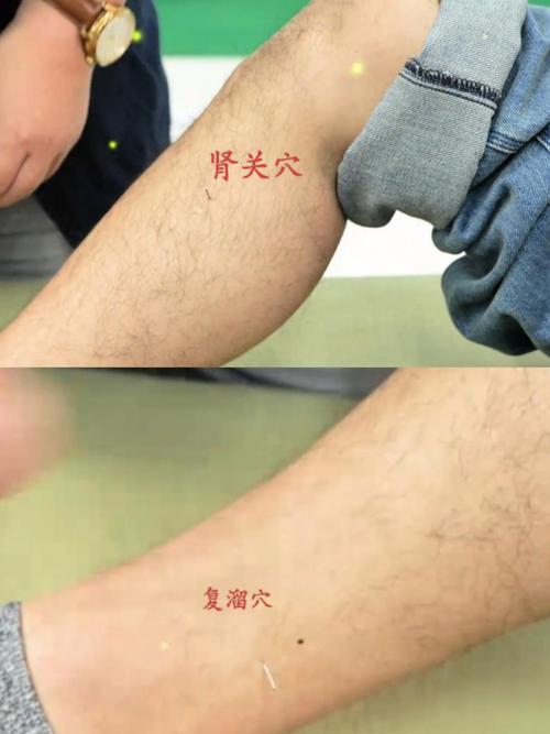 手指麻木针灸哪些穴位