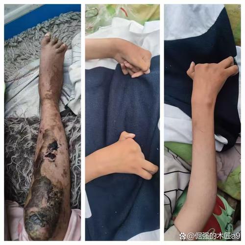 类风湿生孩子 风湿家园