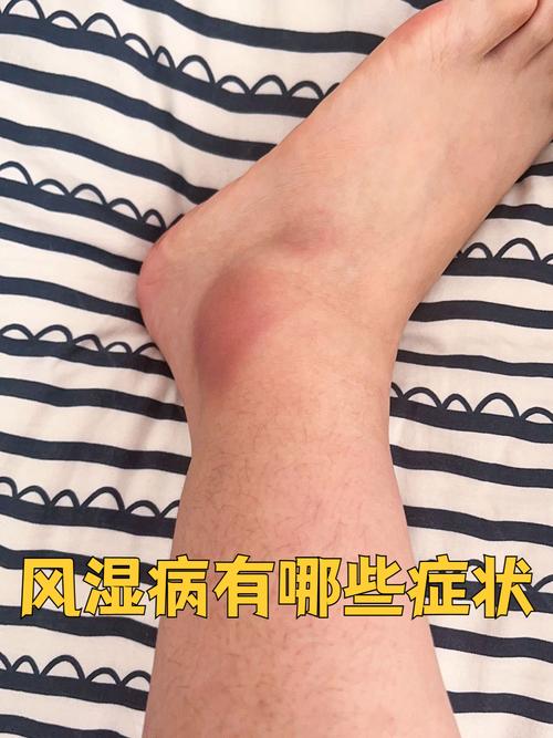 冬季生人易得风湿类风湿