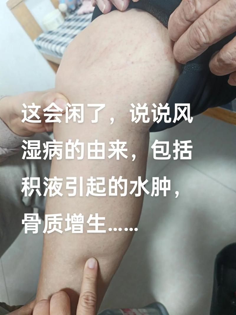 风湿下雨难受就是风湿吗