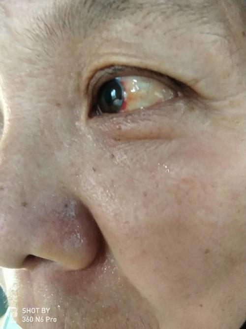 脑梗患者眼底充血的症状