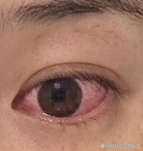 脑梗患者眼底充血的症状