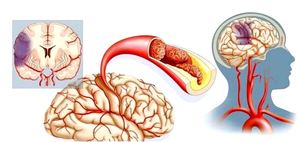 脑梗溶栓好还是不溶栓好
