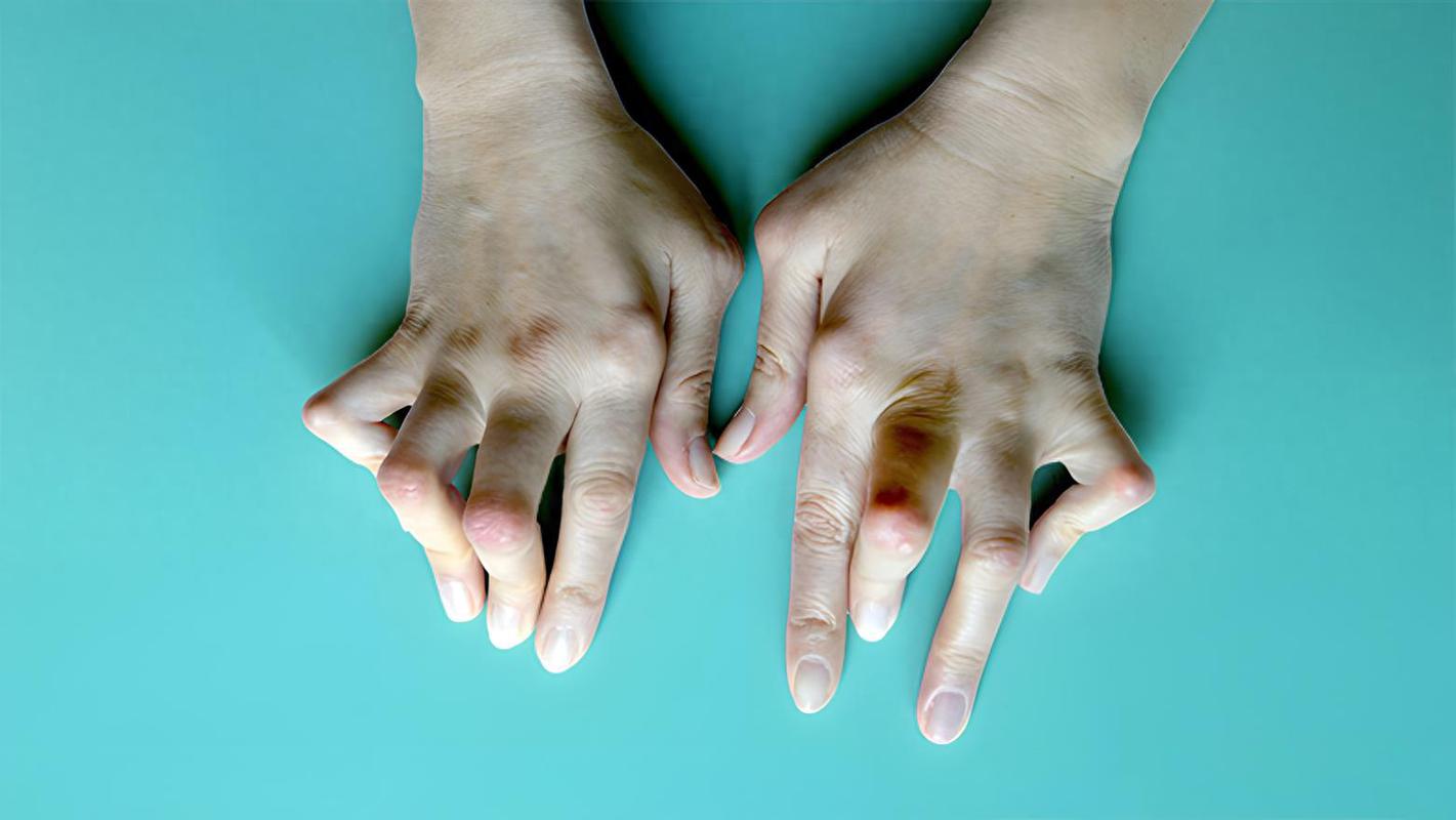 风湿 类风湿是什么症状