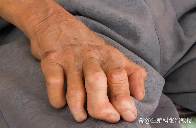 唐山开滦医院风湿类风湿