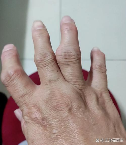 唐山开滦医院风湿类风湿