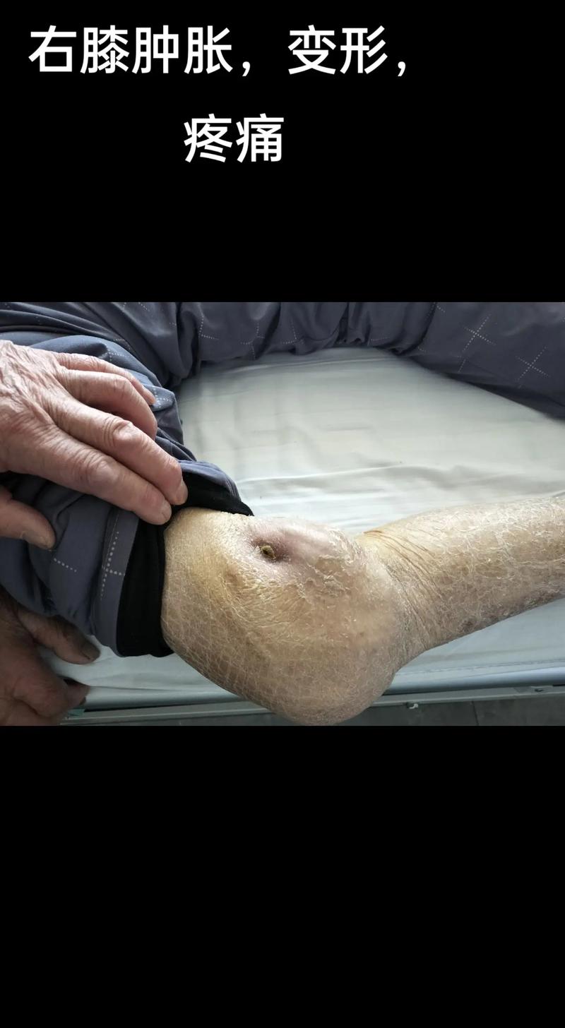 风湿 类风湿做什么检查