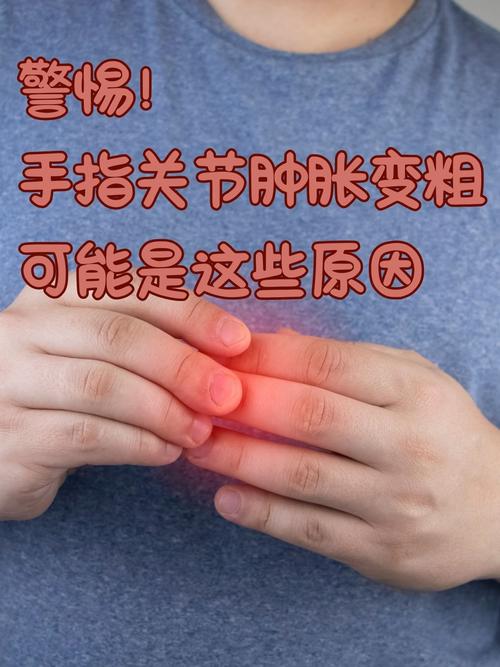 手指肿 风湿还是类风湿