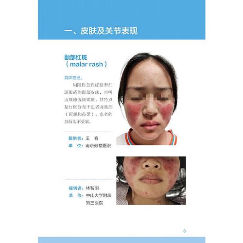 风湿类风湿疾病检查方法