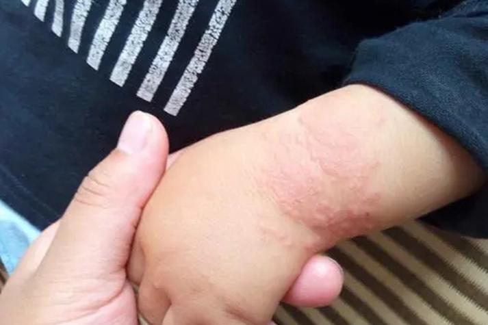 小孩风湿类风湿什么症状