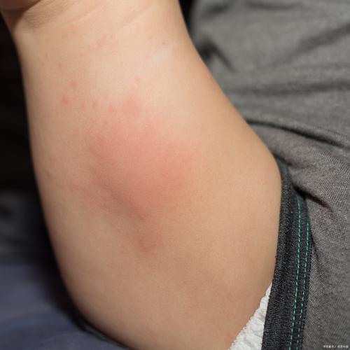 小孩风湿类风湿什么症状