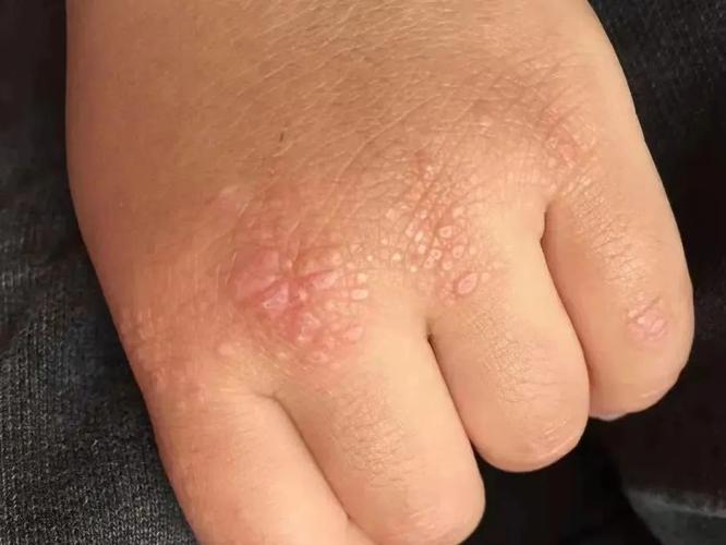 小孩风湿类风湿什么症状