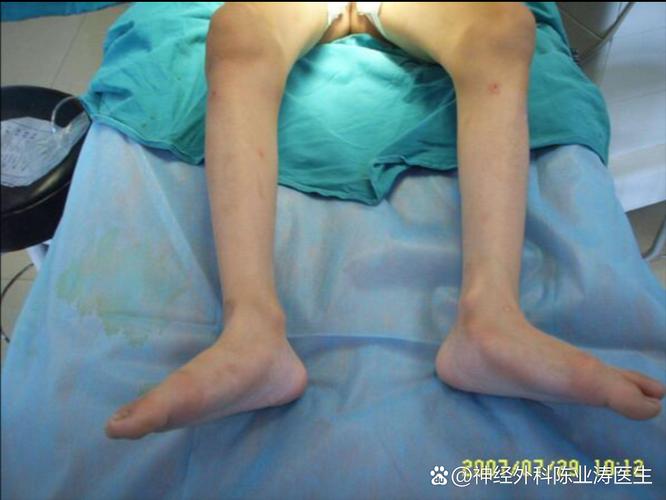 轻度脑梗导致半身瘫痪