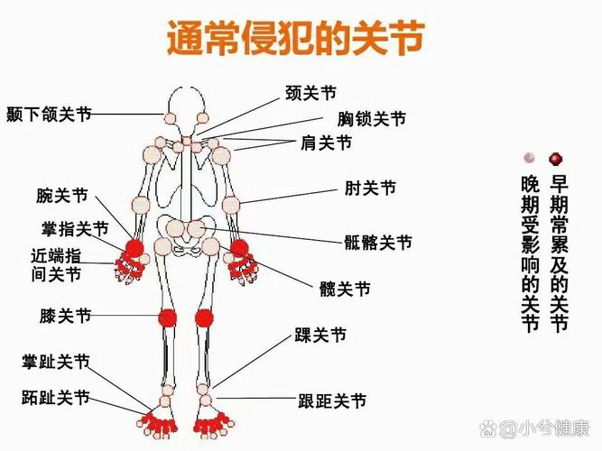 类风湿性关节炎好发部位