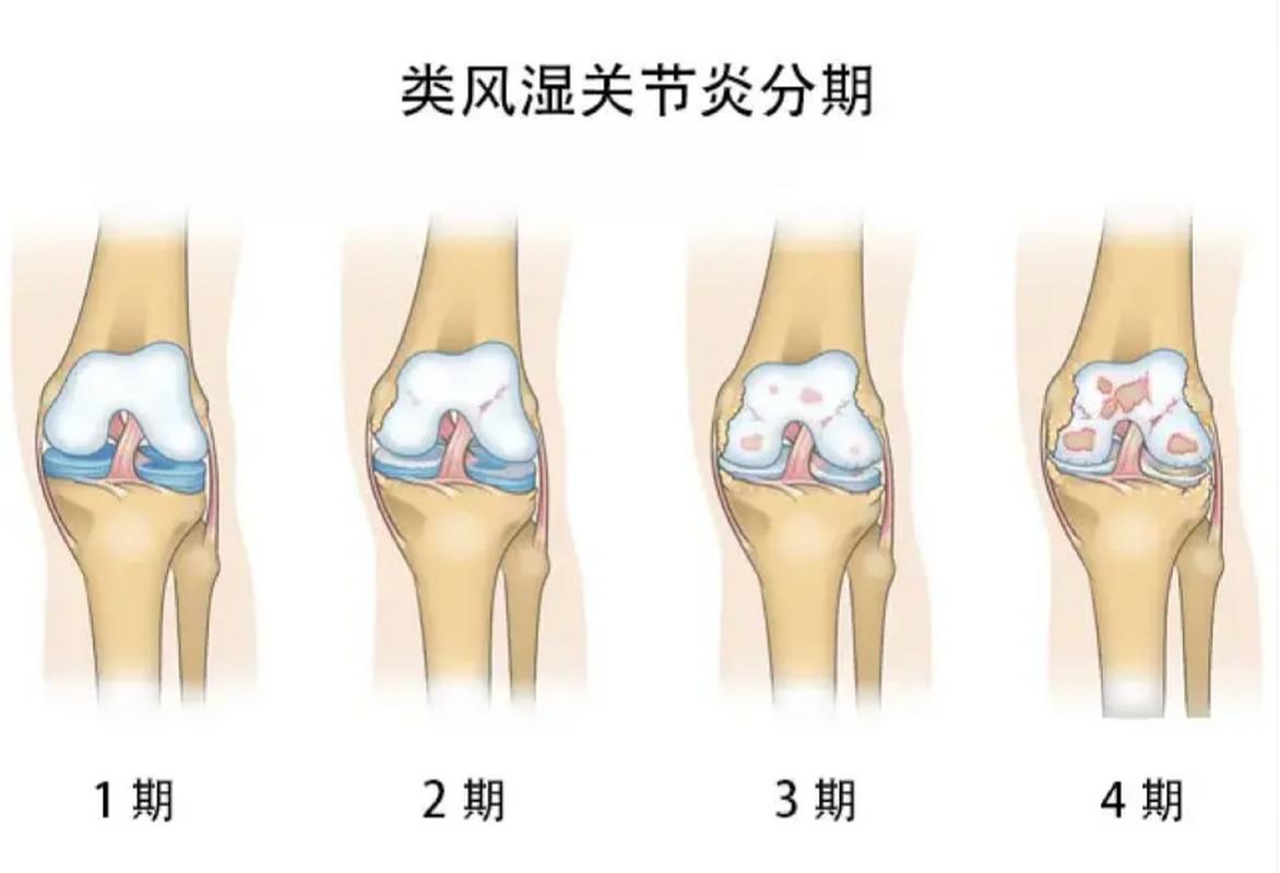 类风湿性关节炎好发部位