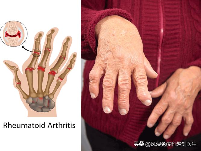 类风湿性关节炎好发部位