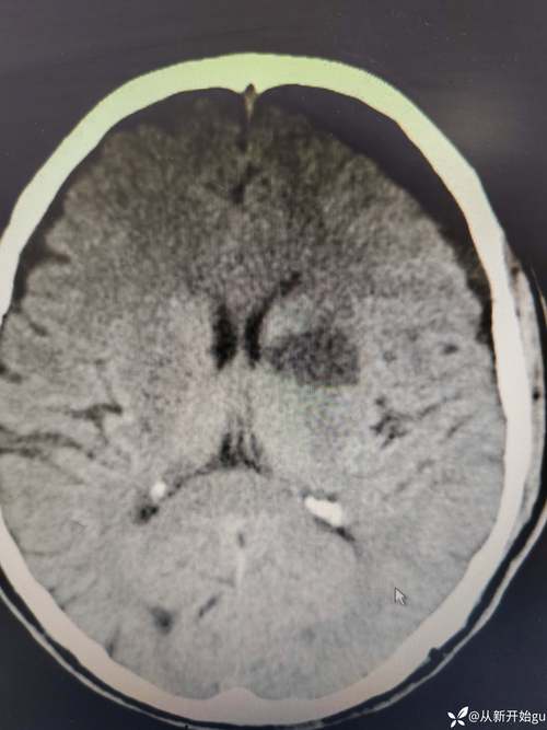 北京301总医院脑梗