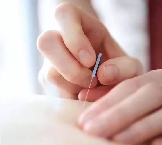 类风湿性关节炎针灸治疗