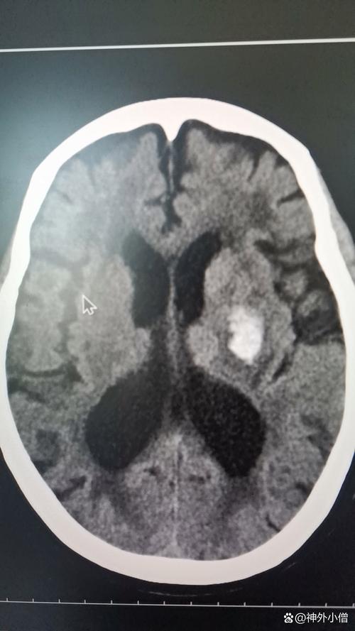 脑梗出血积液脑干变形