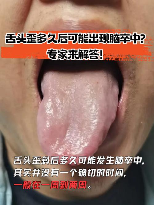 脑梗舌头牙齿慢慢发麻