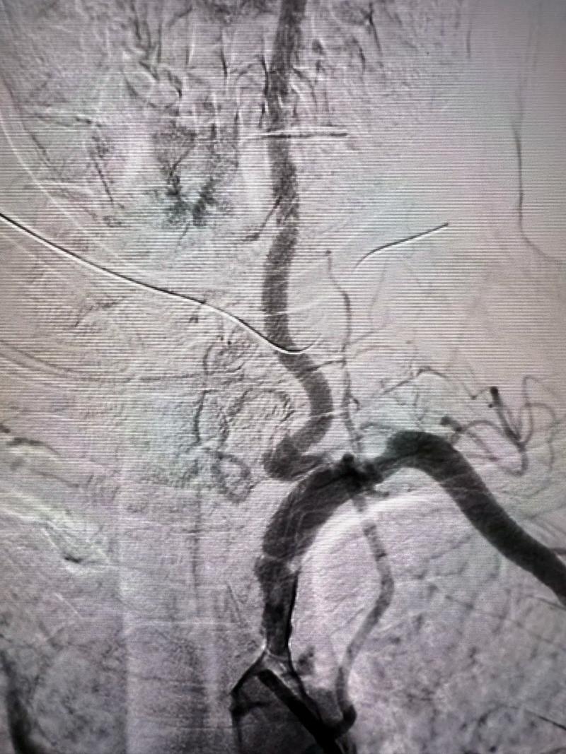 重庆脑梗支架最好医院