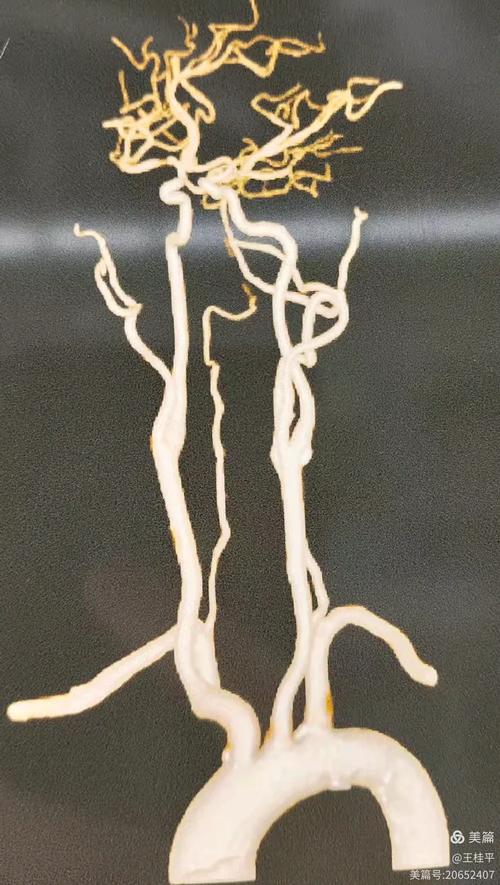 脑梗患者多处血管狭窄