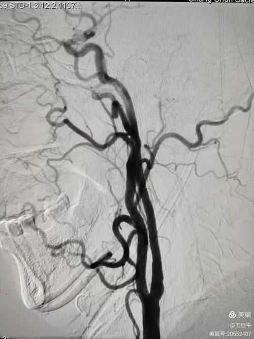 脑梗患者多处血管狭窄