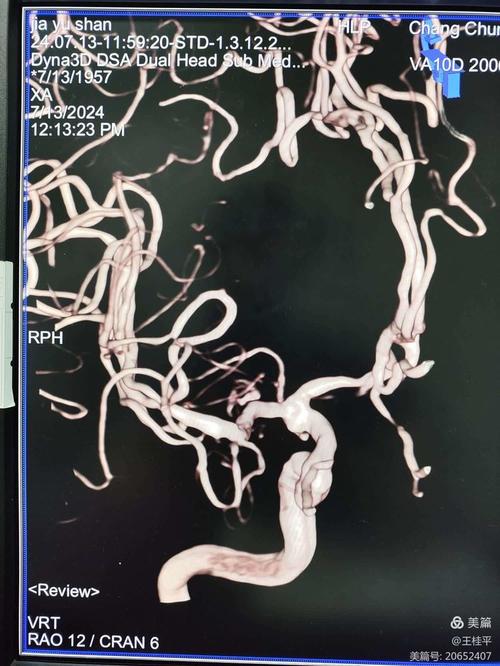 颈内动脉狭窄急性脑梗