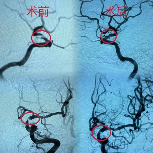 颈内动脉狭窄急性脑梗