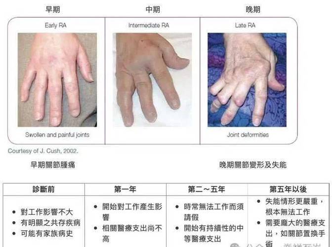 类风湿关节炎的主要表现