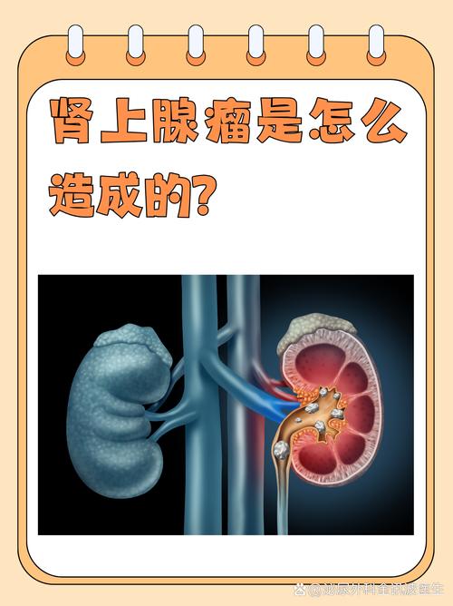 肾上腺腺瘤引起脑梗吗