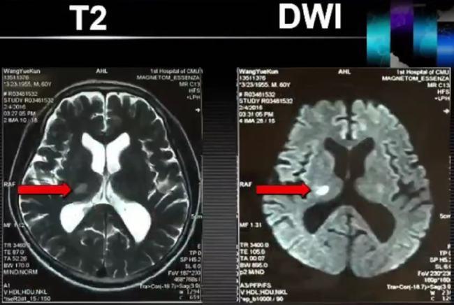 急性脑梗磁共振ppt