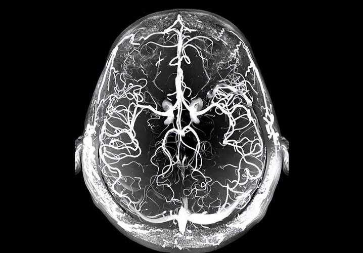 急性脑梗磁共振ppt