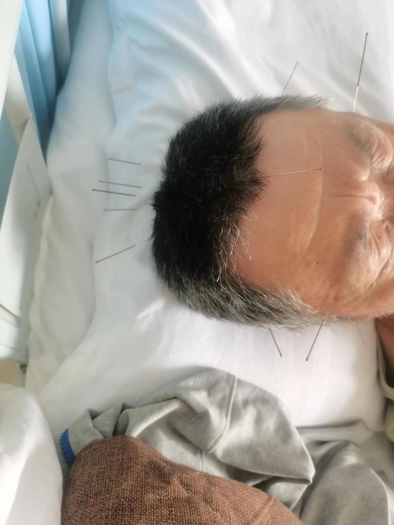 脑梗打针针灸心脏难受