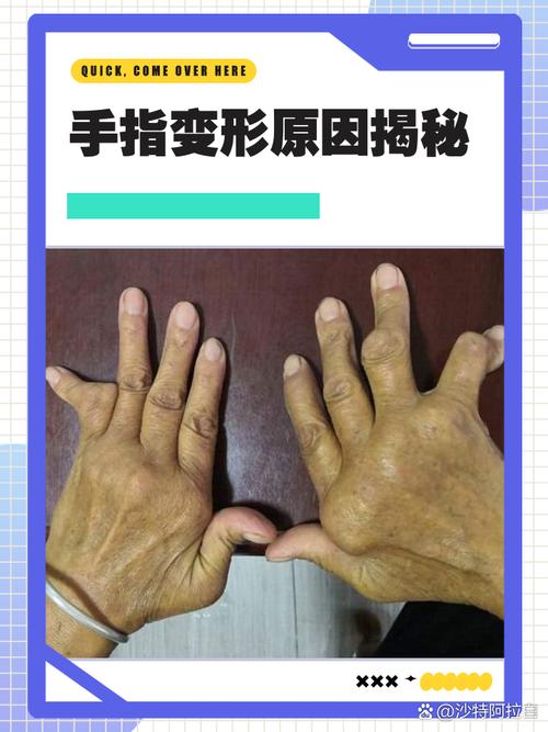 23岁得类风湿手指变形