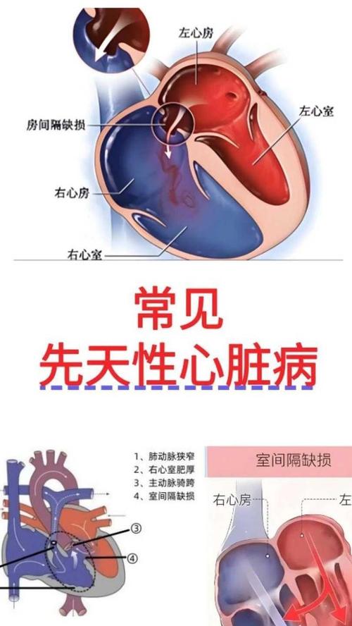 风湿性心脏病是先天的吗