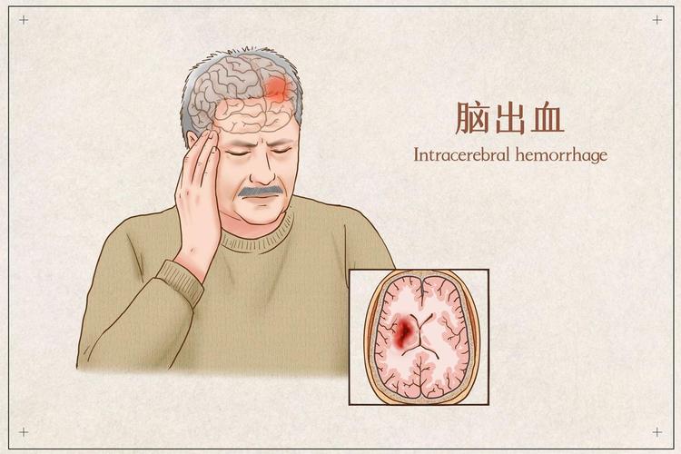 脑梗胃不好吃阿司匹林