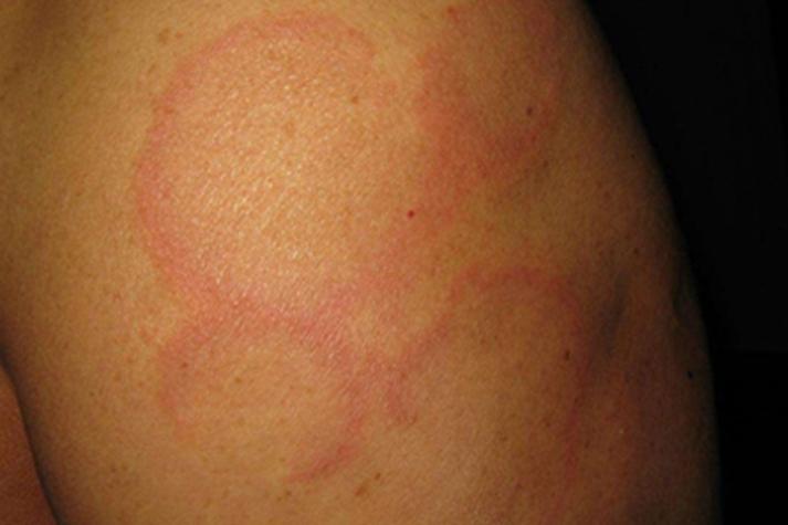 风湿热的具体症状有哪些