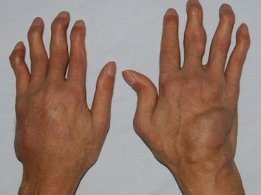 类风湿性关节炎晚期症状