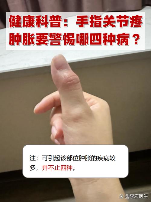 风湿病手指关节疼怎么办