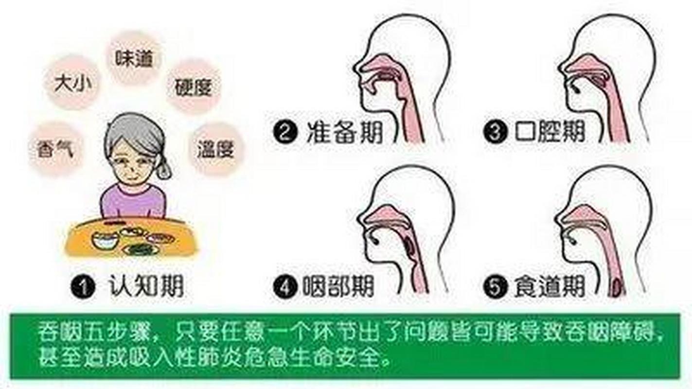 脑梗导致丧失吞咽功能