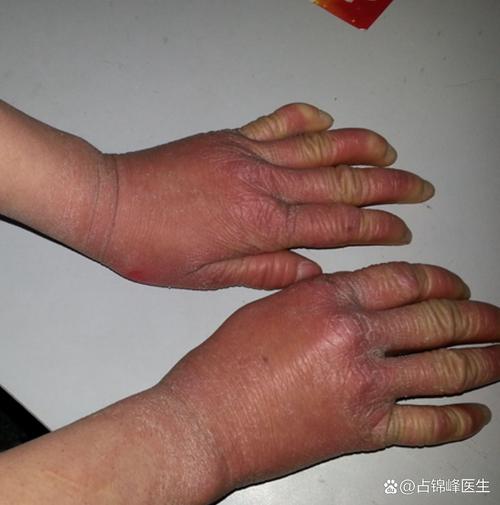 抗环瓜氨酸肽抗体 风湿