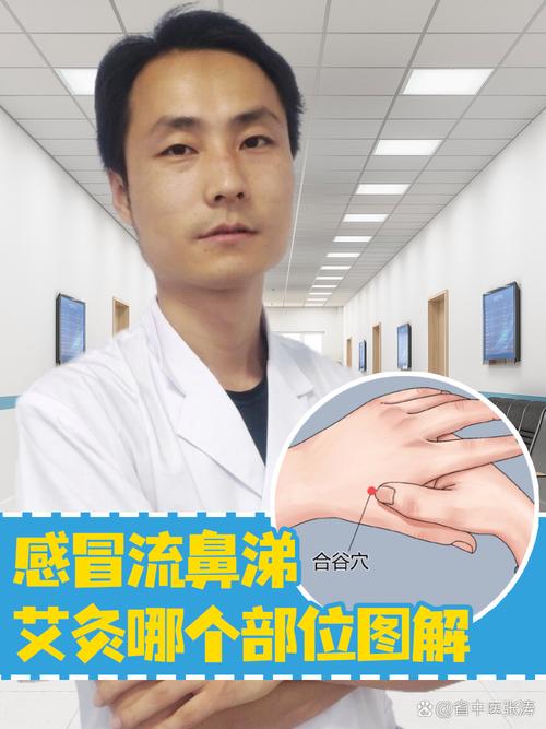 流清水鼻涕 针灸穴位