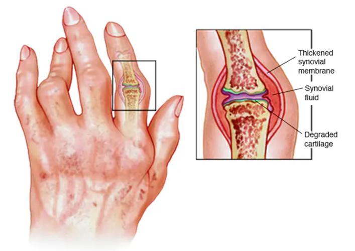 类风湿性关节炎发病机制