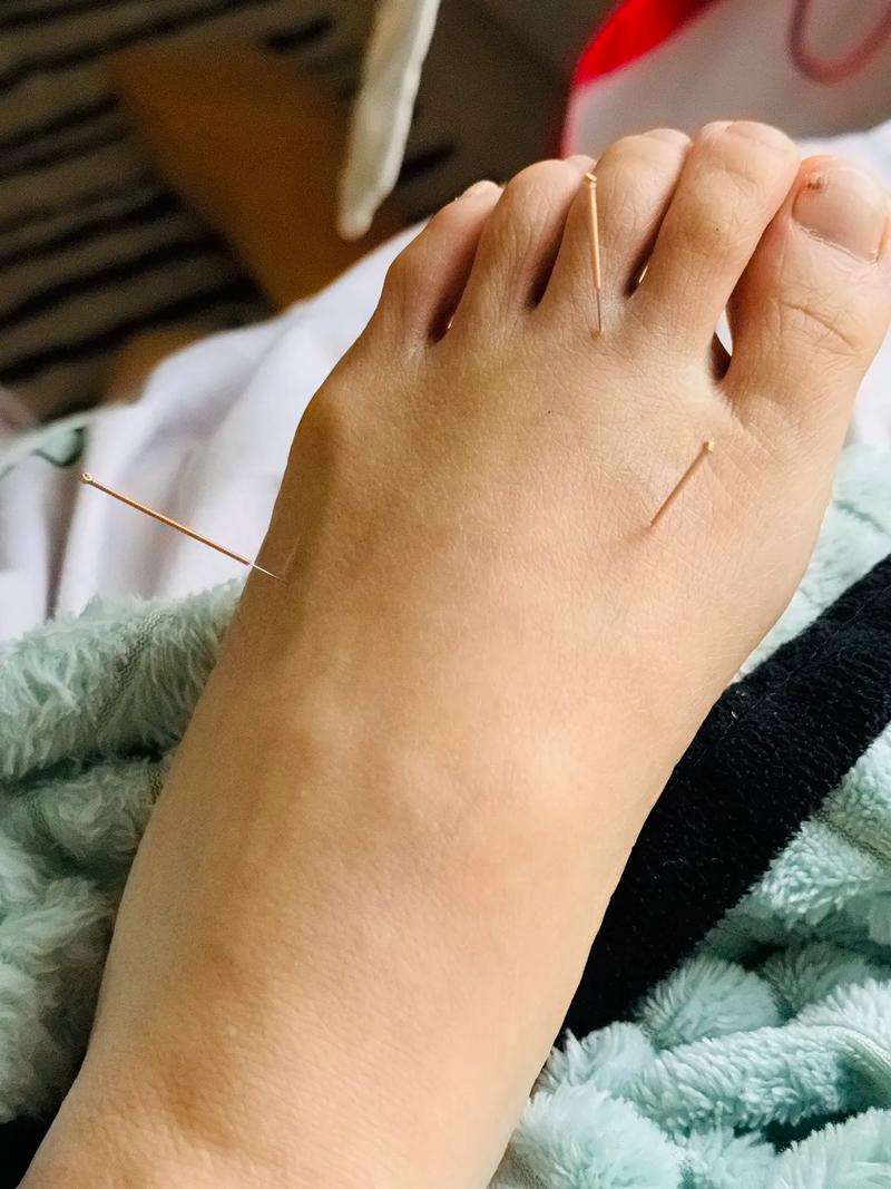 美女体验脚底穴位针灸